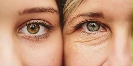 眼周为什么最容易长细纹？该如何预防？